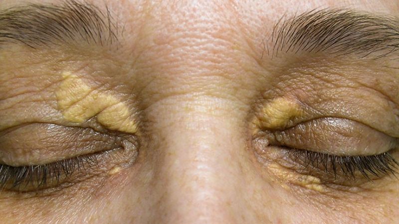 Mí mắt có ban vàng