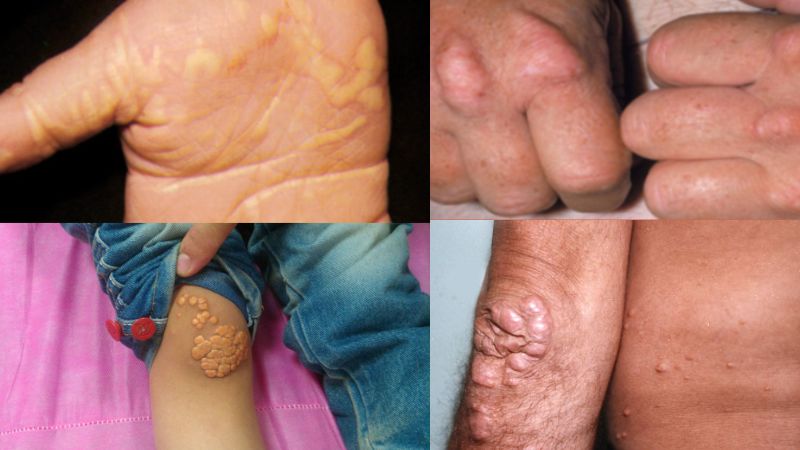 Tổng hợp các loại u vàng ở các vị trí khác nhau