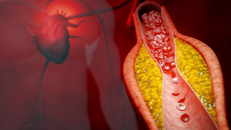 Biến chứng tim mạch và ngoại tim mạch nếu rối loạn lipid máu trở nên nguy hiểm
