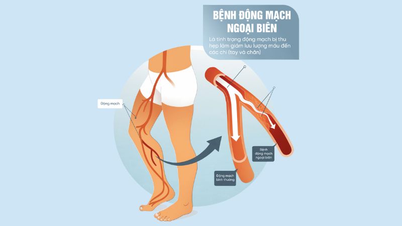 Bệnh động mạch ngoại biên - Biến chứng của rối loạn lipid máu