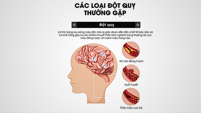 Các loại đột quỵ thường gặp