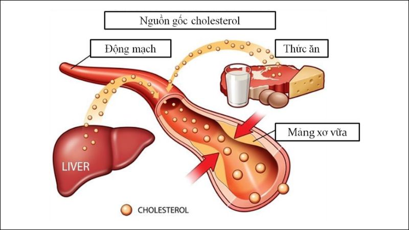 Rối loạn chuyển hóa lipid máu là tình trạng mất cân bằng cholesterol máu