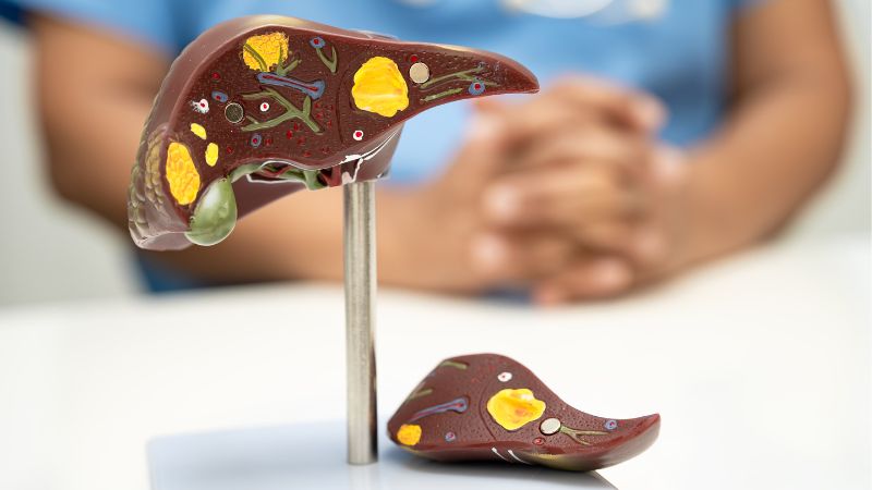  Rối loạn chuyển hóa lipid máu có thể gây biến chứng gan nhiễm mỡ