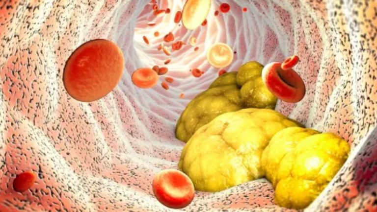 Rối loạn chuyển hóa lipid máu