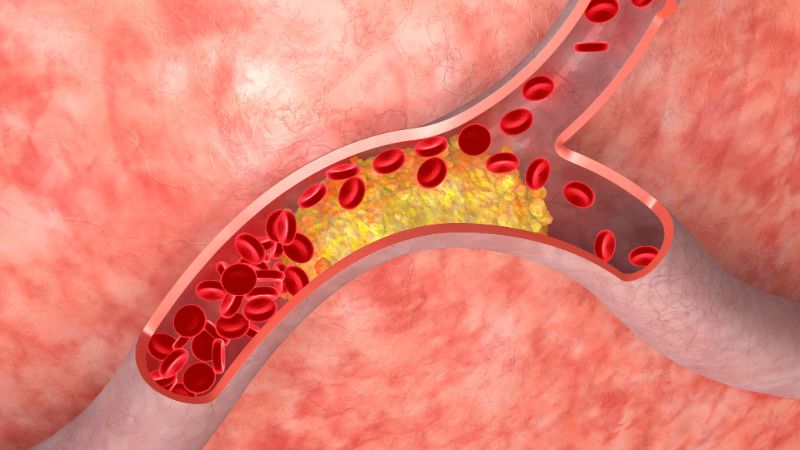 Xơ vữa động mạch là nguyên nhân phổ biến nhất của bệnh tim mạch
