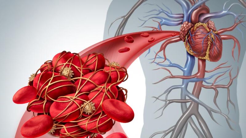 Đột quỵ do huyết khối