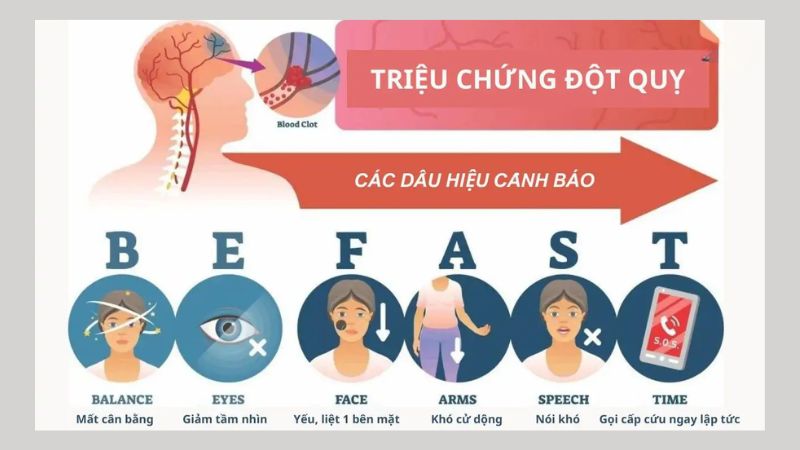 Nhận biết đột quỵ theo nguyên tắc BEFAST