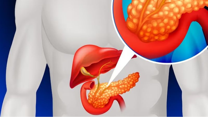 Máu nhiễm mỡ để lâu có thể gây viêm tụy cấp